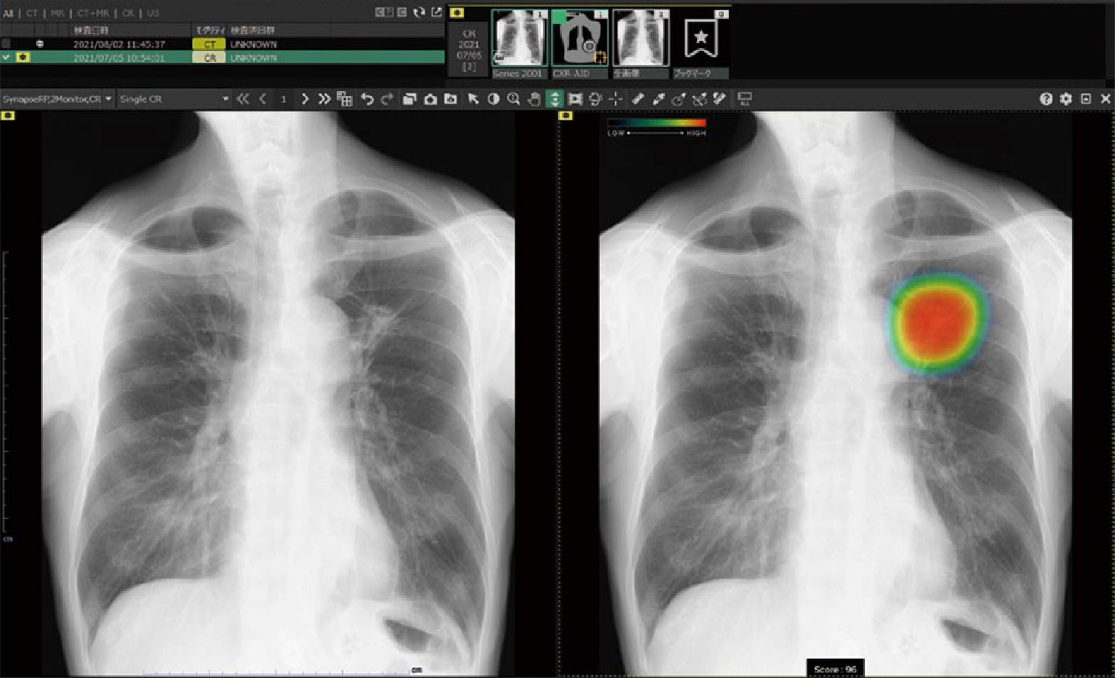 富⼠フイルム社 AI診断システム「CXR-AID」
